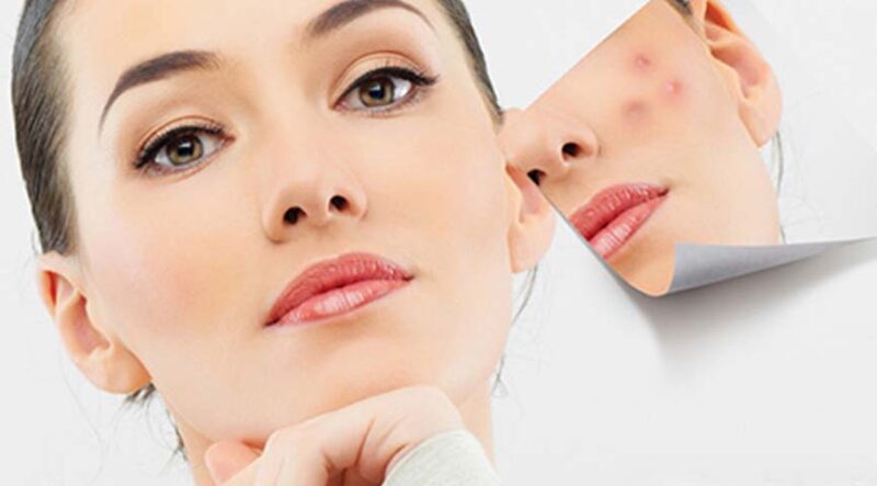 Zit’s Enough Management of Acne in Adults | Rose Pharmacy